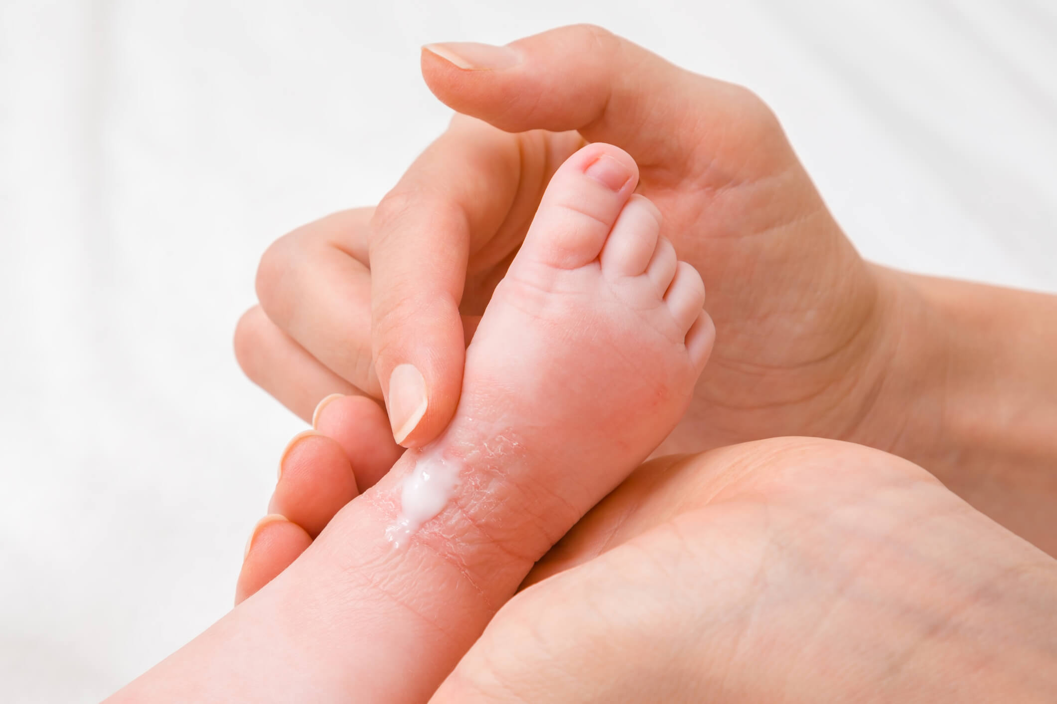 Eczema Du Bebe Symptomes Causes Et Traitements
