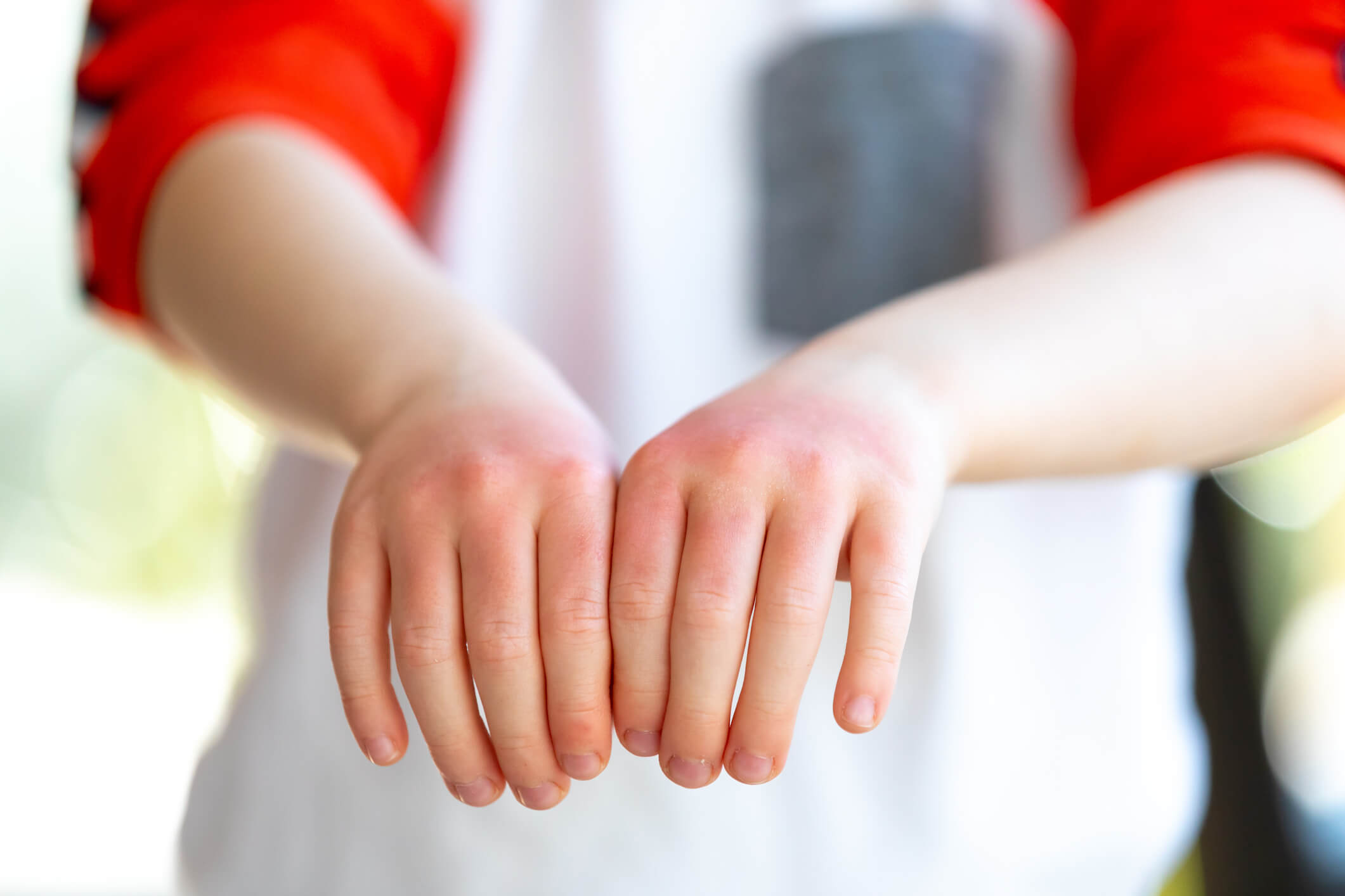 symptôme eczéma