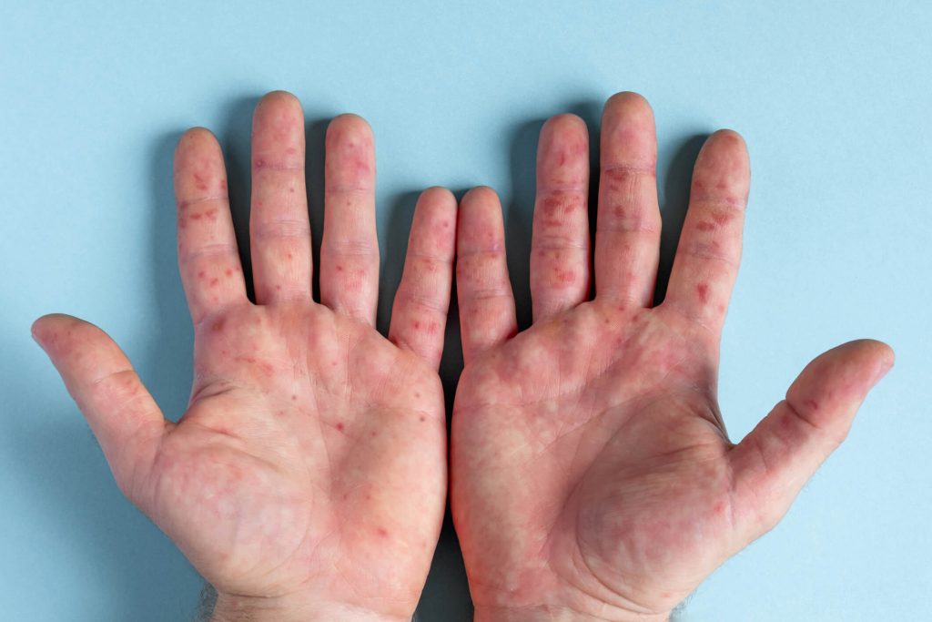 herpès à la main : causes, symptômes et traitement
