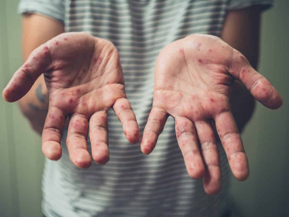 Traitement de la varicelle : comment se soigner soi ou son enfant