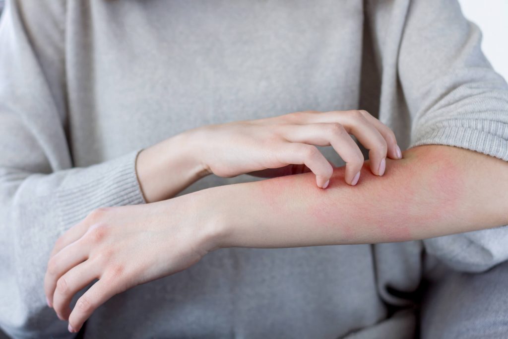 symptomes de l'allergie alimentaire 