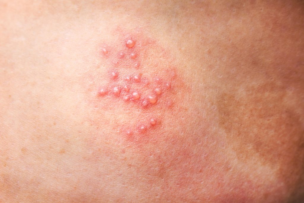 Herpes femme peau