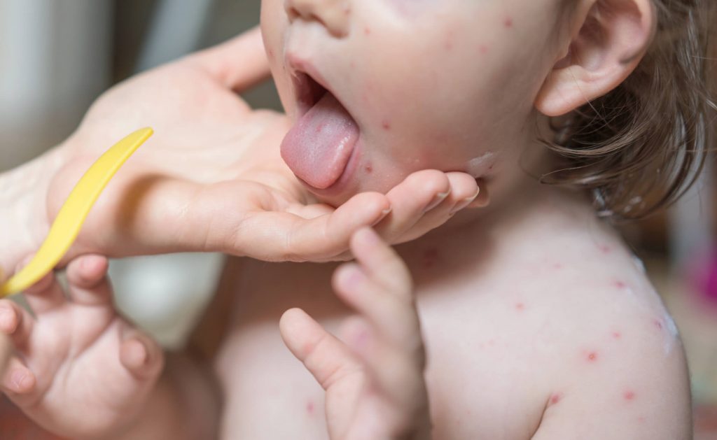 Varicelle enfant