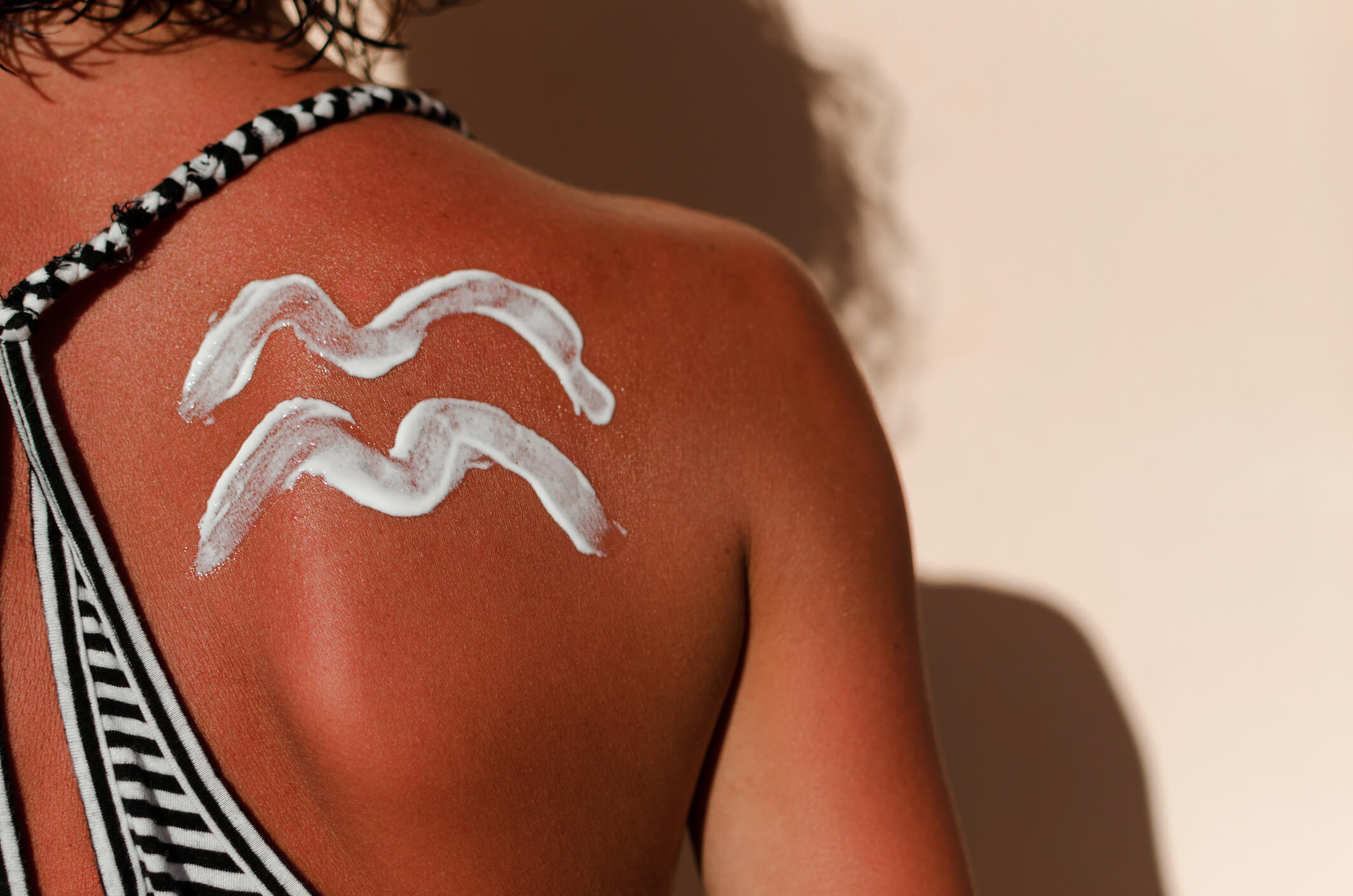 Brûlure coup de soleil