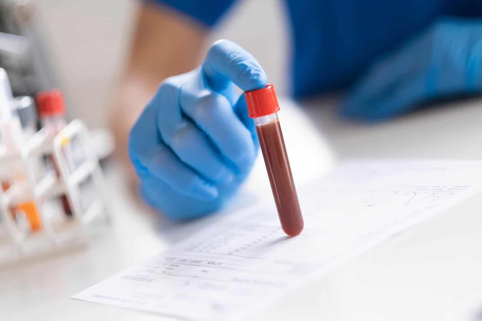 Hématocrite élevé : causes, risques et solutions