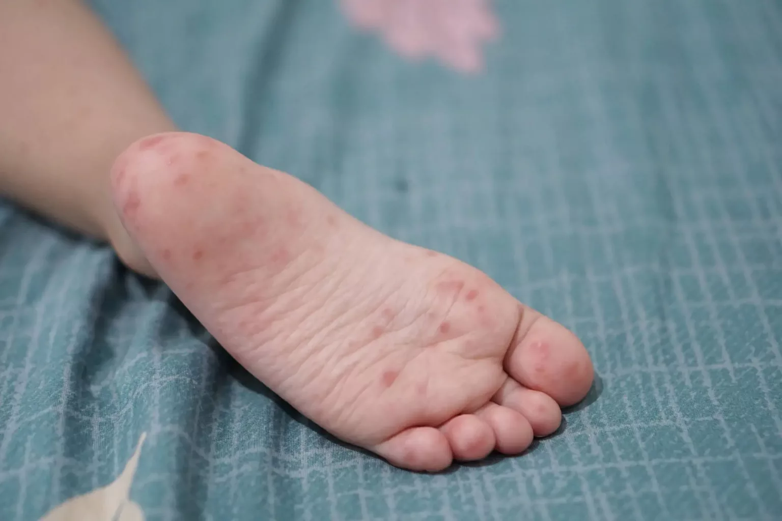 Syndrome piedmainbouche symptômes, traitement et prévention