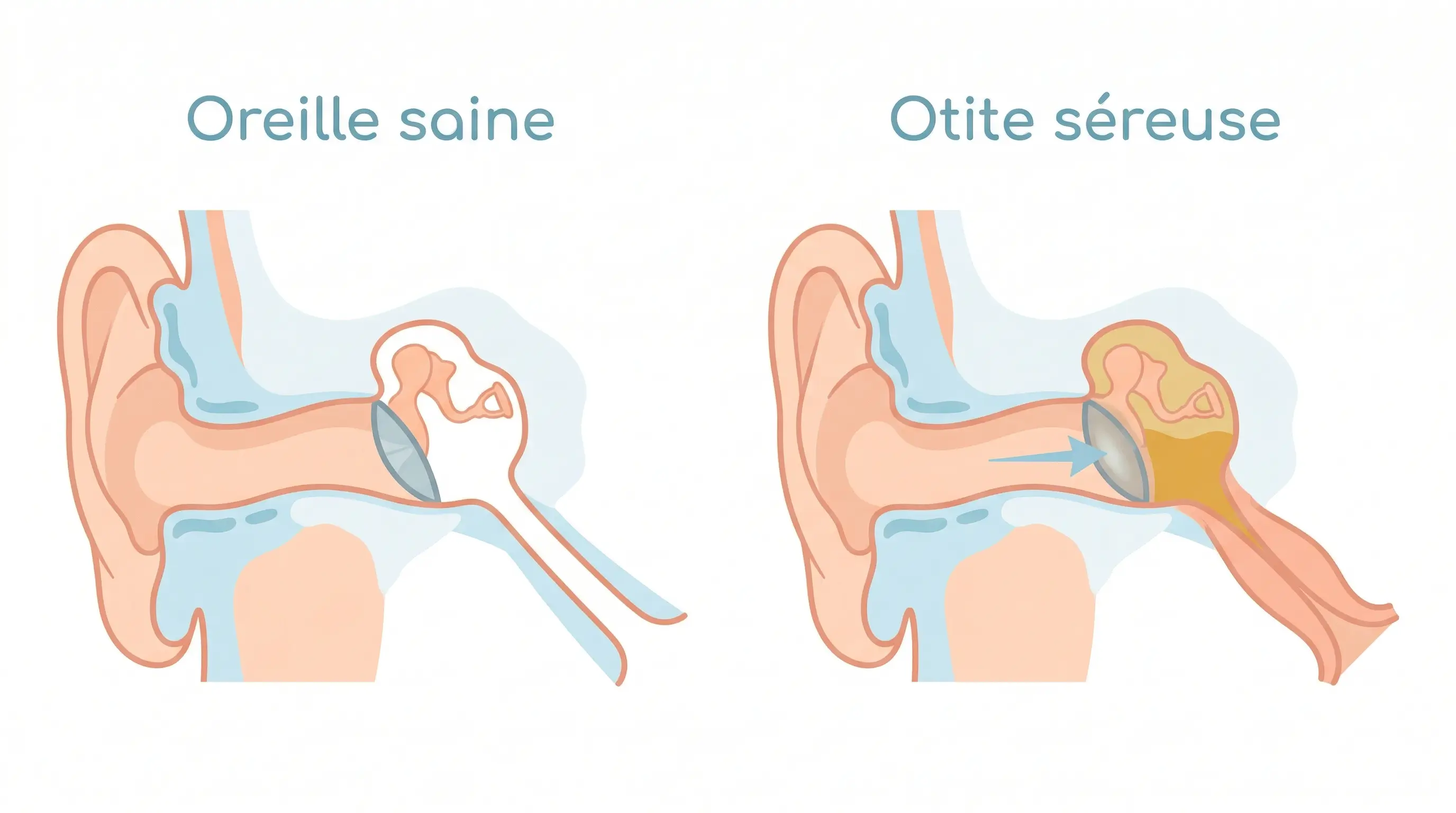 Schéma comparatif d'une oreille saine et d'une oreille atteinte d'otite séreuse avec accumulation de liquide derrière le tympan.