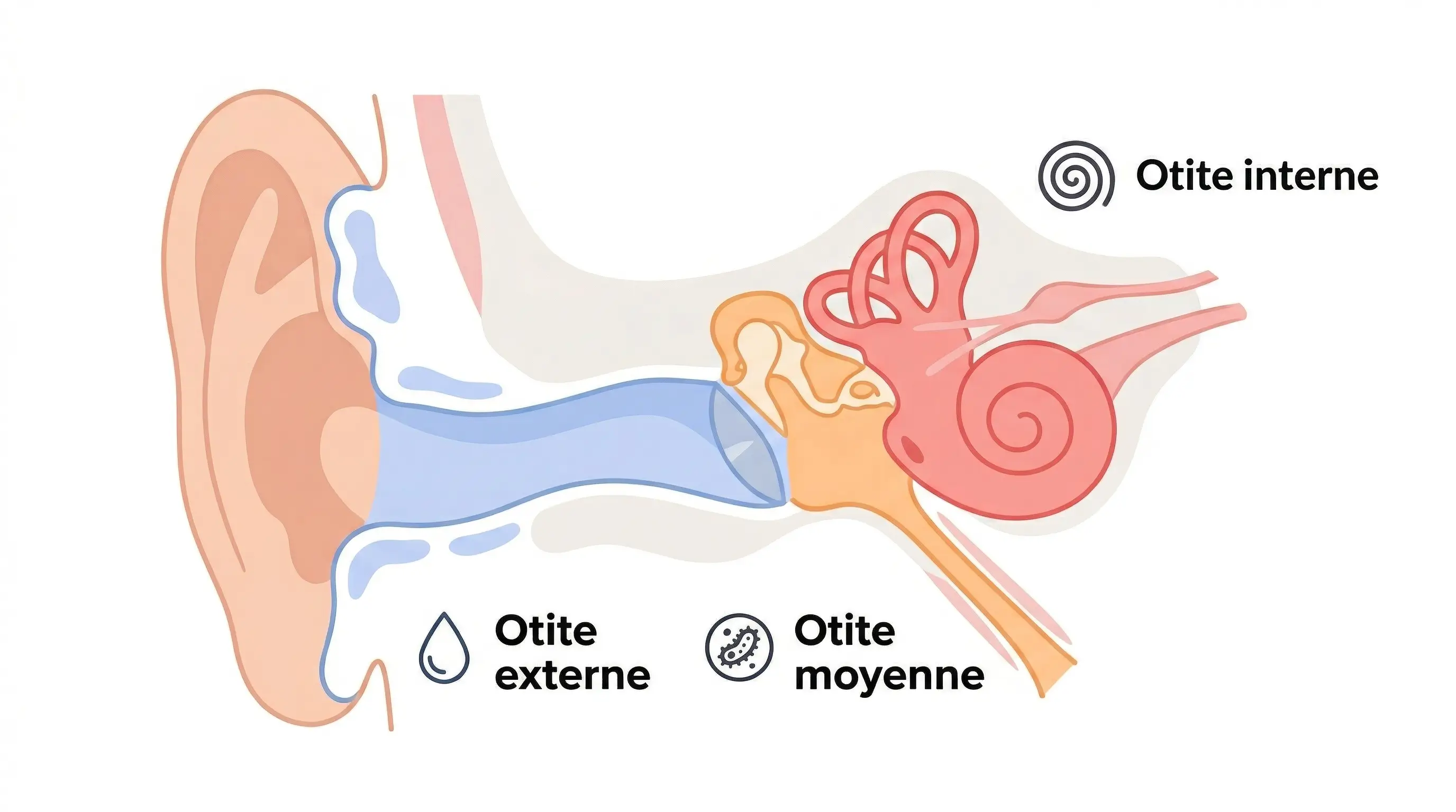 Schéma en coupe de l'oreille illustrant les trois types d'otite avec une otite externe (conduit auditif), otite moyenne (caisse du tympan) et otite interne (labyrinthe).