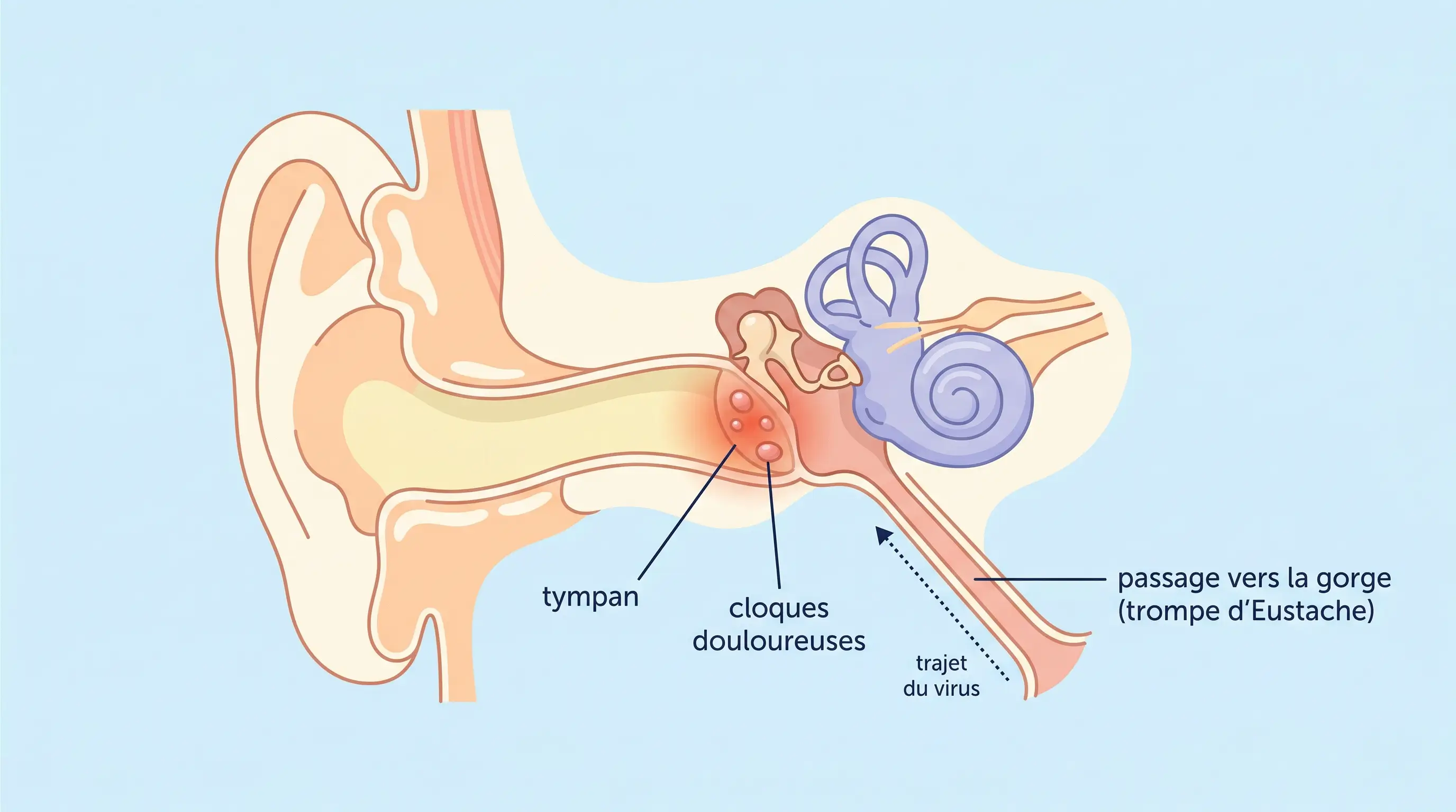 Schéma simplifié de l'oreille en coupe montrant une otite bulleuse avec des cloques sur le tympan formées après la remontée du virus depuis la gorge par la trompe d'Eustache