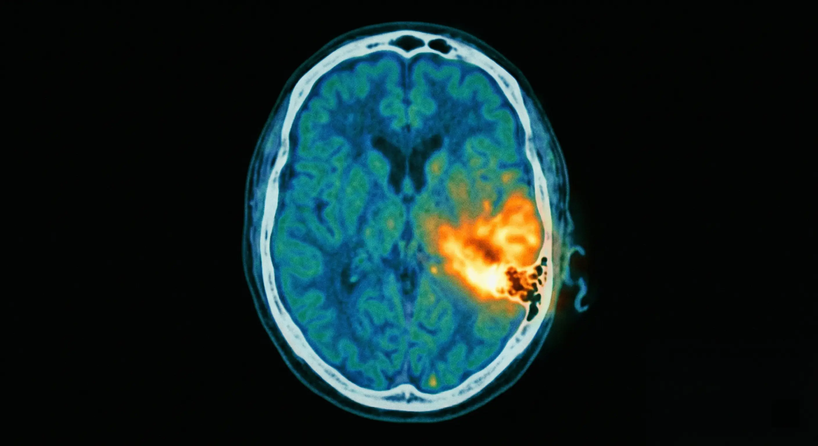 PET scan otite maligne externe hyperfixation au niveau de l'os temporal gauche sur coupe axiale cérébrale
